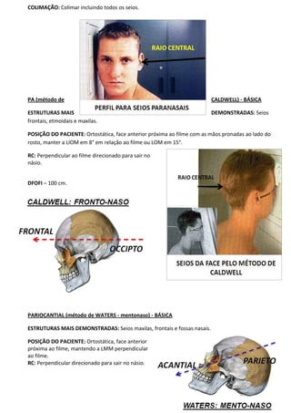 139
COLIMAÇÃO: Colimar incluindo todos os seios.
PA (método de CALDWELL) - BÁSICA
ESTRUTURAS MAIS DEMONSTRADAS: Seios
frontais, etmoidais e maxilas.
POSIÇÃO DO PACIENTE: Ortostática, face anterior próxima ao filme com as mãos pronadas ao lado do
rosto, manter a LIOM em 8° em relação ao filme ou LOM em 15°.
RC: Perpendicular ao filme direcionado para sair no
násio.
DFOFI – 100 cm.
PARIOCANTIAL (método de WATERS - mentonaso) - BÁSICA
ESTRUTURAS MAIS DEMONSTRADAS: Seios maxilas, frontais e fossas nasais.
POSIÇÃO DO PACIENTE: Ortostática, face anterior
próxima ao filme, mantendo a LMM perpendicular
ao filme.
RC: Perpendicular direcionado para sair no násio.
 