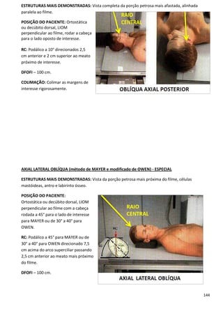 144
ESTRUTURAS MAIS DEMONSTRADAS: Vista completa da porção petrosa mais afastada, alinhada
paralela ao filme.
POSIÇÃO DO PACIENTE: Ortostática
ou decúbito dorsal, LIOM
perpendicular ao filme, rodar a cabeça
para o lado oposto de interesse.
RC: Podálico a 10° direcionados 2,5
cm anterior e 2 cm superior ao meato
próximo de interesse.
DFOFI – 100 cm.
COLIMAÇÃO: Colimar as margens de
interesse rigorosamente.
AXIAL LATERAL OBLÍQUA (método de MAYER e modificado de OWEN) - ESPECIAL
ESTRUTURAS MAIS DEMONSTRADAS: Vista da porção petrosa mais próxima do filme, células
mastóideas, antro e labirinto ósseo.
POSIÇÃO DO PACIENTE:
Ortostática ou decúbito dorsal, LIOM
perpendicular ao filme com a cabeça
rodada a 45° para o lado de interesse
para MAYER ou de 30° a 40° para
OWEN.
RC: Podálico a 45° para MAYER ou de
30° a 40° para OWEN direcionado 7,5
cm acima do arco superciliar passando
2,5 cm anterior ao meato mais próximo
do filme.
DFOFI – 100 cm.
 