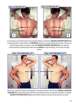 26
As ilustrações acima demonstram duas posições oblíquas. A primeira, OBLÍQUA ANTERIOR DIREITA (1)
é adotada quando o lado afetado é o ESQUERDO. Nesse caso, o lado afetado não encosta no bucky. Na
segunda figura, pode-se visualizar a posição OBLÍQUA ANTERIOR ESQUERDA (2). Esse segundo
posicionamento é adotado para lesões do lado DIREITO. O lado lesionado, não encosta no bucky
vertical.
Nesse caso, podemos observar duas posições em oblíqua posterior. Na primeira, OBLÍQUA POSTERIOR
ESQUERDA (1) o lado afetado pela lesão ficará encostado no bucky. Na segunda ilustração, na posição
OBLÍQUA POSTERIOR DIREITA (2) o lado afetado também será posicionado próximo ao bucky.
 