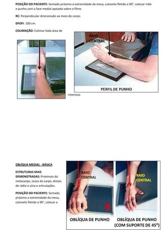 42
POSIÇÃO DO PACIENTE: Sentado próximo a extremidade da mesa, cotovelo fletido a 90°, colocar mão
e punho com a face medial apoiada sobre o filme.
RC: Perpendicular direcionado ao meio do carpo.
DFOFI: 100 cm.
COLIMAÇÃO: Colimar toda área de
interesse.
OBLÍQUA MEDIAL - BÁSICA
ESTRUTURAS MAIS
DEMONSTRADAS: Proximais do
metacarpo, ossos do carpo, distais
de rádio e ulna e articulações.
POSIÇÃO DO PACIENTE: Sentado
próximo a extremidade da mesa,
cotovelo fletido a 90°, colocar a
 