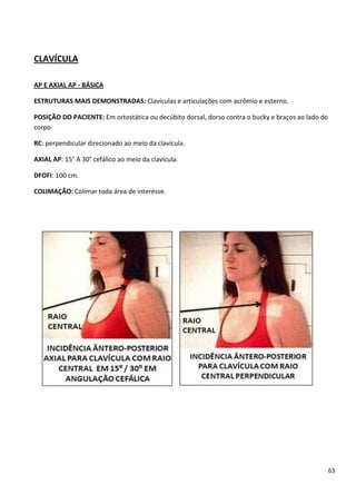 63
CLAVÍCULA
AP E AXIAL AP - BÁSICA
ESTRUTURAS MAIS DEMONSTRADAS: Clavículas e articulações com acrômio e esterno.
POSIÇÃO DO PACIENTE: Em ortostática ou decúbito dorsal, dorso contra o bucky e braços ao lado do
corpo.
RC: perpendicular direcionado ao meio da clavícula.
AXIAL AP: 15° A 30° cefálico ao meio da clavícula.
DFOFI: 100 cm.
COLIMAÇÃO: Colimar toda área de interesse.
 
