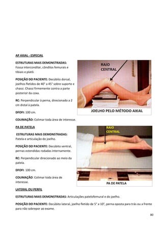 80
AP AXIAL - ESPECIAL
ESTRUTURAS MAIS DEMONSTRADAS:
Fossa intercondilar, côndilos femurais e
tibiais e platô.
POSIÇÃO DO PACIENTE: Decúbito dorsal,
joelhos fletidos de 40° a 45° sobre suporte e
chassi. Chassi firmemente contra a parte
posterior da coxa.
RC: Perpendicular à perna, direcionado a 2
cm distal à patela.
DFOFI: 100 cm.
COLIMAÇÃO: Colimar toda área de interesse.
PA DE PATELA
ESTRUTURAS MAIS DEMONSTRADAS:
Patela e articulação do joelho.
POSIÇÃO DO PACIENTE: Decúbito ventral,
pernas estendidas rodadas internamente.
RC: Perpendicular direcionado ao meio da
patela.
DFOFI: 100 cm.
COLIMAÇÃO: Colimar toda área de
interesse.
LATERAL OU PERFIL
ESTRUTURAS MAIS DEMONSTRADAS: Articulações patelofemural e do joelho.
POSIÇÃO DO PACIENTE: Decúbito lateral, joelho fletido de 5° a 10°, perna oposta para trás ou a frente
para não sobrepor ao exame.
 