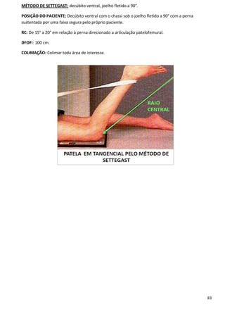 83
MÉTODO DE SETTEGAST: decúbito ventral, joelho fletido a 90°.
POSIÇÃO DO PACIENTE: Decúbito ventral com o chassi sob o joelho fletido a 90° com a perna
sustentada por uma faixa segura pelo próprio paciente.
RC: De 15° a 20° em relação à perna direcionado a articulação patelofemural.
DFOFI: 100 cm.
COLIMAÇÃO: Colimar toda área de interesse.
 