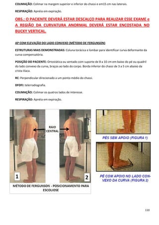 110
COLIMAÇÃO: Colimar na margem superior e inferior do chassi e em15 cm nas laterais.
RESPIRAÇÃO: Apnéia em expiração.
OBS.: O PACIENTE DEVERÁ ESTAR DESCALÇO PARA REALIZAR ESSE EXAME e
A REGIÃO DA CURVATURA ANORMAL DEVERÁ ESTAR ENCOSTADA NO
BUCKY VERTICAL.
AP COM ELEVAÇÃO DO LADO CONVEXO (MÉTODO DE FERGUNSON)
ESTRUTURAS MAIS DEMONSTRADAS: Coluna torácica e lombar para identificar curva deformante da
curva compensatória.
POSIÇÃO DO PACIENTE: Ortostática ou sentado com suporte de 8 a 10 cm em baixo do pé ou quadril
do lado convexo da curva, braços ao lado do corpo. Borda inferior do chassi de 3 a 5 cm abaixo da
crista ilíaca.
RC: Perpendicular direcionado a um ponto médio do chassi.
DFOFI: telerradiografia.
COLIMAÇÃO: Colimar os quatros lados de interesse.
RESPIRAÇÃO: Apnéia em expiração.
 