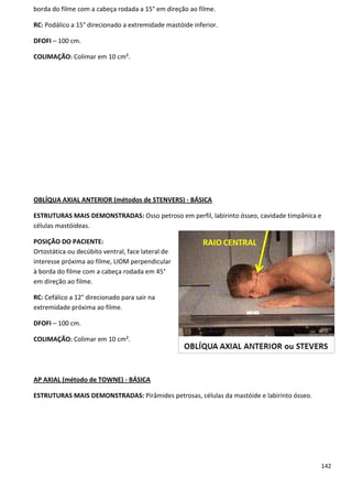 142
borda do filme com a cabeça rodada a 15° em direção ao filme.
RC: Podálico a 15° direcionado a extremidade mastóide inferior.
DFOFI – 100 cm.
COLIMAÇÃO: Colimar em 10 cm².
OBLÍQUA AXIAL ANTERIOR (métodos de STENVERS) - BÁSICA
ESTRUTURAS MAIS DEMONSTRADAS: Osso petroso em perfil, labirinto ósseo, cavidade timpânica e
células mastóideas.
POSIÇÃO DO PACIENTE:
Ortostática ou decúbito ventral, face lateral de
interesse próxima ao filme, LIOM perpendicular
à borda do filme com a cabeça rodada em 45°
em direção ao filme.
RC: Cefálico a 12° direcionado para sair na
extremidade próxima ao filme.
DFOFI – 100 cm.
COLIMAÇÃO: Colimar em 10 cm².
AP AXIAL (método de TOWNE) - BÁSICA
ESTRUTURAS MAIS DEMONSTRADAS: Pirâmides petrosas, células da mastóide e labirinto ósseo.
 