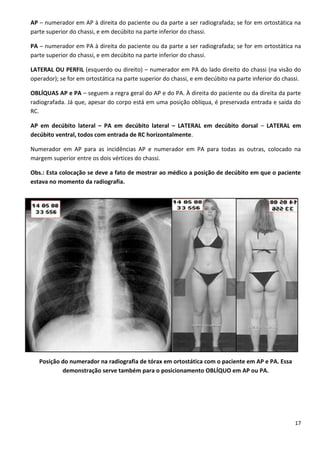 17
AP – numerador em AP à direita do paciente ou da parte a ser radiografada; se for em ortostática na
parte superior do chassi, e em decúbito na parte inferior do chassi.
PA – numerador em PA à direita do paciente ou da parte a ser radiografada; se for em ortostática na
parte superior do chassi, e em decúbito na parte inferior do chassi.
LATERAL OU PERFIL (esquerdo ou direito) – numerador em PA do lado direito do chassi (na visão do
operador); se for em ortostática na parte superior do chassi, e em decúbito na parte inferior do chassi.
OBLÍQUAS AP e PA – seguem a regra geral do AP e do PA. À direita do paciente ou da direita da parte
radiografada. Já que, apesar do corpo está em uma posição oblíqua, é preservada entrada e saída do
RC.
AP em decúbito lateral – PA em decúbito lateral – LATERAL em decúbito dorsal – LATERAL em
decúbito ventral, todos com entrada de RC horizontalmente.
Numerador em AP para as incidências AP e numerador em PA para todas as outras, colocado na
margem superior entre os dois vértices do chassi.
Obs.: Esta colocação se deve a fato de mostrar ao médico a posição de decúbito em que o paciente
estava no momento da radiografia.
Posição do numerador na radiografia de tórax em ortostática com o paciente em AP e PA. Essa
demonstração serve também para o posicionamento OBLÍQUO em AP ou PA.
 
