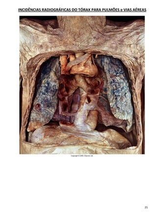 21
INCIDÊNCIAS RADIOGRÁFICAS DO TÓRAX PARA PULMÕES e VIAS AÉREAS
 