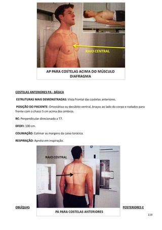 119
COSTELAS ANTERIORES PA - BÁSICA
ESTRUTURAS MAIS DEMONSTRADAS: Vista frontal das costelas anteriores.
POSIÇÃO DO PACIENTE: Ortostática ou decúbito ventral, braços ao lado do corpo e rodados para
frente com o chassi 5 cm acima dos ombros.
RC: Perpendicular direcionado a T7.
DFOFI: 100 cm.
COLIMAÇÃO: Colimar as margens da caixa torácica.
RESPIRAÇÃO: Apnéia em inspiração.
OBLÍQUAS POSTERIORES E
 