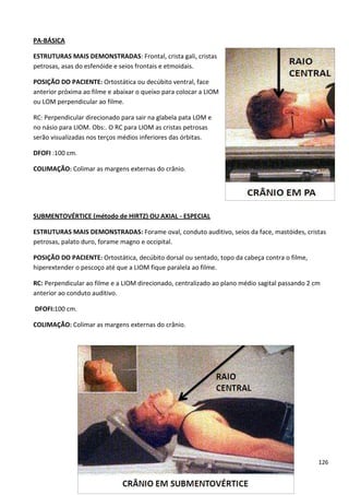 126
PA-BÁSICA
ESTRUTURAS MAIS DEMONSTRADAS: Frontal, crista gali, cristas
petrosas, asas do esfenóide e seios frontais e etmoidais.
POSIÇÃO DO PACIENTE: Ortostática ou decúbito ventral, face
anterior próxima ao filme e abaixar o queixo para colocar a LIOM
ou LOM perpendicular ao filme.
RC: Perpendicular direcionado para sair na glabela pata LOM e
no násio para LIOM. Obs:. O RC para LIOM as cristas petrosas
serão visualizadas nos terços médios inferiores das órbitas.
DFOFI :100 cm.
COLIMAÇÃO: Colimar as margens externas do crânio.
SUBMENTOVÉRTICE (método de HIRTZ) OU AXIAL - ESPECIAL
ESTRUTURAS MAIS DEMONSTRADAS: Forame oval, conduto auditivo, seios da face, mastóides, cristas
petrosas, palato duro, forame magno e occipital.
POSIÇÃO DO PACIENTE: Ortostática, decúbito dorsal ou sentado, topo da cabeça contra o filme,
hiperextender o pescoço até que a LIOM fique paralela ao filme.
RC: Perpendicular ao filme e a LIOM direcionado, centralizado ao plano médio sagital passando 2 cm
anterior ao conduto auditivo.
DFOFI:100 cm.
COLIMAÇÃO: Colimar as margens externas do crânio.
 