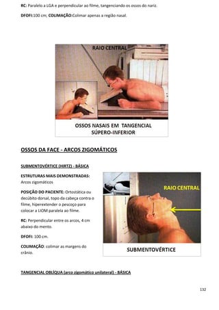 132
RC: Paralelo a LGA e perpendicular ao filme, tangenciando os ossos do nariz.
DFOFI:100 cm; COLIMAÇÃO:Colimar apenas a região nasal.
OSSOS DA FACE - ARCOS ZIGOMÁTICOS
SUBMENTOVÉRTICE (HIRTZ) - BÁSICA
ESTRUTURAS MAIS DEMONSTRADAS:
Arcos zigomáticos
POSIÇÃO DO PACIENTE: Ortostática ou
decúbito dorsal, topo da cabeça contra o
filme, hiperextender o pescoço para
colocar a LIOM paralela ao filme.
RC: Perpendicular entre os arcos, 4 cm
abaixo do mento.
DFOFI: 100 cm.
COLIMAÇÃO: colimar as margens do
crânio.
TANGENCIAL OBLÍQUA (arco zigomático unilateral) - BÁSICA
 