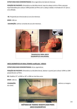 133
ESTRUTURAS MAIS DEMONSTRADAS: Arco zigomático do lado de interesse.
POSIÇÃO DO PACIENTE: Ortostática ou decúbito dorsal, topo da cabeça contra o filme, pescoço
hiperextendido para colocar LIOM paralela ao filme com a cabeça rodada e inclinada em 15° para o
arco afetado.
RC: Perpendicular direcionado ao arco de interesse.
DFOFI: 100 cm.
COLIMAÇÃO: colimar as bordas do arco de interesse.
ARCO ZIGOMÁTICO AP AXIAL (TOWNE modificado) - BÁSICA
ESTRUTURAS MAIS DEMONSTRADAS: Arcos zigomáticos
POSIÇÃO DO PACIENTE: Ortostática ou decúbito dorsal, abaixar o queixo para colocar LIOM ou LOM
perpendicular ao filme.
RC: Podálico 37° a LIOM ou 30° a LOM ao nível dos arcos.
DFOFI: 100 cm.
COLIMAÇÃO: colimar as margens
do crânio.
 