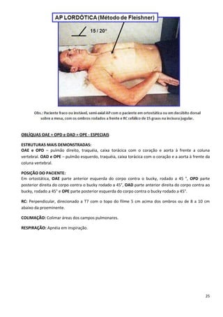 25
OBLÍQUAS OAE = OPD e OAD = OPE - ESPECIAIS
ESTRUTURAS MAIS DEMONSTRADAS:
OAE e OPD – pulmão direito, traquéia, caixa torácica com o coração e aorta à frente a coluna
vertebral. OAD e OPE – pulmão esquerdo, traquéia, caixa torácica com o coração e a aorta à frente da
coluna vertebral.
POSIÇÃO DO PACIENTE:
Em ortostática, OAE parte anterior esquerda do corpo contra o bucky, rodado a 45 °, OPD parte
posterior direita do corpo contra o bucky rodado a 45°, OAD parte anterior direita do corpo contra ao
bucky, rodado a 45° e OPE parte posterior esquerda do corpo contra o bucky rodado a 45°.
RC: Perpendicular, direcionado a T7 com o topo do filme 5 cm acima dos ombros ou de 8 a 10 cm
abaixo da proeminente.
COLIMAÇÃO: Colimar áreas dos campos pulmonares.
RESPIRAÇÃO: Apnéia em inspiração.
 