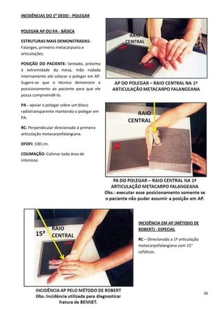 36
INCIDÊNCIAS DO 1⁰ DEDO - POLEGAR
POLEGAR AP OU PA - BÁSICA
ESTRUTURAS MAIS DEMONSTRADAS:
Falanges, primeiro metacarpiano e
articulações.
POSIÇÃO DO PACIENTE: Sentado, próximo
à extremidade da mesa, mão rodada
internamente até colocar o polegar em AP.
Sugere-se que o técnico demonstre o
posicionamento ao paciente para que ele
possa compreendê-lo.
PA - apoiar o polegar sobre um bloco
radiotransparente mantendo o polegar em
PA.
RC: Perpendicular direcionado à primeira
articulação metacarpofalangiana.
DFOFI: 100 cm.
COLIMAÇÃO: Colimar toda área de
interesse.
INCIDÊNCIA EM AP (MÉTODO DE
ROBERT) - ESPECIAL
RC – Direcionado a 1ª articulação
metecarpofalangiana com 15°
cefálicos.
 