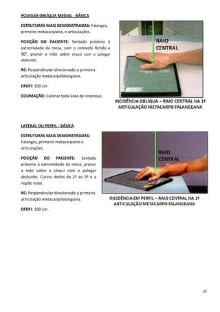 37
POLEGAR OBLÍQUA MEDIAL - BÁSICA
ESTRUTURAS MAIS DEMONSTRADAS: Falanges,
primeiro metacarpiano, e articulações.
POSIÇÃO DO PACIENTE: Sentado próximo à
extremidade da mesa, com o cotovelo fletido a
90°, pronar a mão sobre chassi com o polegar
abduzido.
RC: Perpendicular direcionado a primeira
articulação metacarpofalangiana.
DFOFI: 100 cm
COLIMAÇÃO: Colimar toda área de interesse.
LATERAL OU PERFIL - BÁSICA
ESTRUTURAS MAIS DEMONSTRADAS:
Falanges, primeiro metacarpiano e
articulações.
POSIÇÃO DO PACIENTE: Sentado
próximo à extremidade da mesa, pronar
a mão sobre o chassi com o polegar
abduzido. Curvar dedos do 2º ao 5º e a
região volar.
RC: Perpendicular direcionado a primeira
articulação metacarpofalangiana.
DFOFI: 100 cm.
 