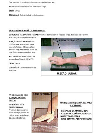 43
face medial sobre o chassi e depois rodar medialmente 45°.
RC: Perpendicular direcionado ao meio do carpo.
DFOFI: 100 cm
COLIMAÇÃO: Colimar toda área de interesse.
PA DO ESCAFÓIDE (FLEXÃO ULNAR) - ESPECIAL
ESTRUTURAS MAIS DEMONSTRADAS: Proximais do metacarpo, ossos do carpo, distais de rádio e ulna
e articulações do escafóide abertas.
POSIÇÃO DO PACIENTE: Sentado
próximo a extremidade da mesa,
cotovelo fletido a 90°, com a face
anterior do punho sobre o chassi e a
mão flexionada em direção a ulna.
RC: Direcionado ao escafóide com
angulação cefálica de 10º a 15º.
DFOFI: 100 cm
COLIMAÇÃO: Colimar toda área de
interesse.
PA DO ESCAFÓIDE COM
ELEVAÇÃO DA MÃO -
ESPECIAL
ESTRUTURAS MAIS
DEMONSTRADAS:
Proximais do metacarpo,
ossos do carpo, distais de
rádio e ulna e articulações
do escafóide abertas.
 