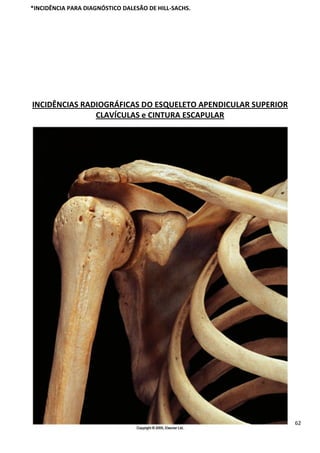 62
*INCIDÊNCIA PARA DIAGNÓSTICO DALESÃO DE HILL-SACHS.
INCIDÊNCIAS RADIOGRÁFICAS DO ESQUELETO APENDICULAR SUPERIOR
CLAVÍCULAS e CINTURA ESCAPULAR
 