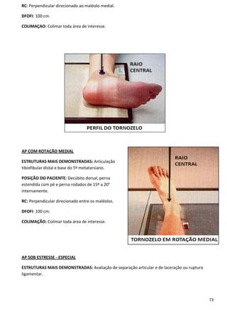 73
RC: Perpendicular direcionado ao maléolo medial.
DFOFI: 100 cm.
COLIMAÇAO: Colimar toda área de interesse.
AP COM ROTAÇÃO MEDIAL
ESTRUTURAS MAIS DEMONSTRADAS: Articulação
tibiofibular distal e base do 5º metatarsiano.
POSIÇÃO DO PACIENTE: Decúbito dorsal, perna
estendida com pé e perna rodados de 15º a 20°
internamente.
RC: Perpendicular direcionado entre os maléolos.
DFOFI: 100 cm.
COLIMAÇÃO: Colimar toda área de interesse.
AP SOB ESTRESSE - ESPECIAL
ESTRUTURAS MAIS DEMONSTRADAS: Avaliação de separação articular e de laceração ou ruptura
ligamentar.
 
