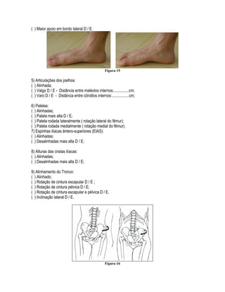 ( ) Maior apoio em bordo lateral D / E.
Figura 15
5) Articulações dos joelhos:
( ) Alinhada;
( ) Valgo D / E - Distância entre maléolos internos:...............cm;
( ) Varo D / E - Distância entre côndilos internos:.................cm;
6) Patelas:
( ) Alinhadas;
( ) Patela mais alta D / E;
( ) Patela rodada lateralmente ( rotação lateral do fêmur);
( ) Patela rodada medialmente ( rotação medial do fêmur).
7) Espinhas ilíacas ântero-superiores (EIAS):
( ) Alinhadas;
( ) Desalinhadas mais alta D / E;
8) Alturas das cristas ilíacas:
( ) Alinhadas;
( ) Desalinhadas mais alta D / E;
9) Alinhamento do Tronco:
( ) Alinhado;
( ) Rotação de cintura escapular D / E ;
( ) Rotação de cintura pélvica D / E;
( ) Rotação de cintura escapular e pélvica D / E.
( ) Inclinação lateral D / E.
Figura 16
 