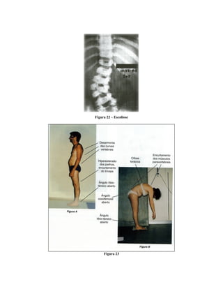 Figura 22 – Escoliose
Figura 23
 