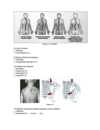 Figura 12 - Escoliose
8) Coluna Torácica:
( ) Alinhada;
( ) Convexidade D / E.
9) Ângulos inferiores da escápula:
( ) Alinhados;
( ) Desalinhados mais alto D / E.
10) Posição das escápulas:
( ) Alinhadas;
( ) Alada (s) D / E;
( ) Abduzida D / E;
( ) Aduzida D / E.
Figura 13
11) Distância entre bordo medial da escápula e coluna vertebral:
( ) Simétrica;
( ) Assimétrica (D: .......cm e E: .......cm).
 