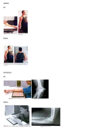 UMERO
AP
PERFIL
COTOVELO
AP
PERFIL
 