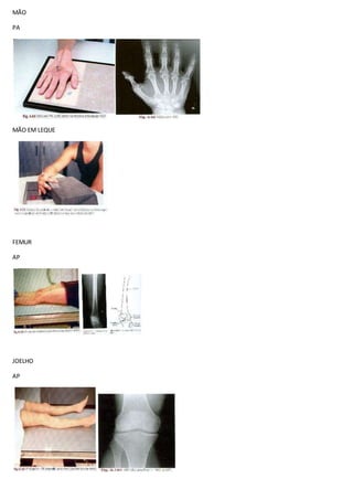 MÃO
PA
MÃO EM LEQUE
FEMUR
AP
JOELHO
AP
 