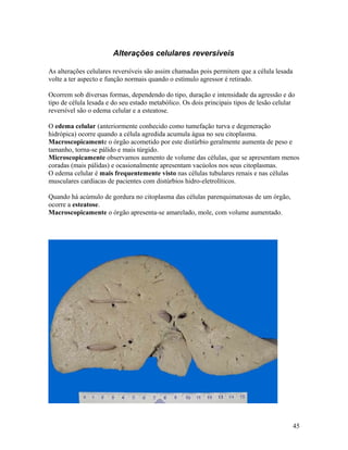 Alterações celulares reversíveis
As alterações celulares reversíveis são assim chamadas pois permitem que a célula lesada
volte a ter aspecto e função normais quando o estímulo agressor é retirado.
Ocorrem sob diversas formas, dependendo do tipo, duração e intensidade da agressão e do
tipo de célula lesada e do seu estado metabólico. Os dois principais tipos de lesão celular
reversível são o edema celular e a esteatose.
O edema celular (anteriormente conhecido como tumefação turva e degeneração
hidrópica) ocorre quando a célula agredida acumula água no seu citoplasma.
Macroscopicamente o órgão acometido por este distúrbio geralmente aumenta de peso e
tamanho, torna-se pálido e mais túrgido.
Microscopicamente observamos aumento de volume das células, que se apresentam menos
coradas (mais pálidas) e ocasionalmente apresentam vacúolos nos seus citoplasmas.
O edema celular é mais frequentemente visto nas células tubulares renais e nas células
musculares cardíacas de pacientes com distúrbios hidro-eletrolíticos.
Quando há acúmulo de gordura no citoplasma das células parenquimatosas de um órgão,
ocorre a esteatose.
Macroscopicamente o órgão apresenta-se amarelado, mole, com volume aumentado.
45
 