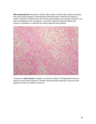 Microscopicamente observamos vacúolos não corados no interior das células acometidas.
Isto ocorre porque durante o processamento laboratorial para confecção das lâminas o
tecido é exposto a substâncias que são solventes das gorduras, que é portanto retirada. Caso
haja necessidade de corar as gorduras, é necessário um processamento especial que
conserva as gorduras e a utilização de corante especifico das gorduras.
A esteatose é mais comum no fígado e no musculo cardíaco. No fígado pode assumir o
aspecto microvacuolar (quando se formam muitas gotículas pequenas) e macrovacuolar
(quando se forma um vacúolo volumoso).
46
 