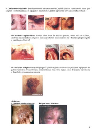 ðCarcinoma basocelular: pode-se manifestar de várias maneiras, feridas que não cicatrizam ou lesões que
sangram com facilidade devido a pequenos traumatismos, podem representar um Carcinoma basocelular.
ðCarcinoma espinocelular: acomete mais áreas da mucosa aparente, como boca ou o lábio,
cicatrizes de queimaduras antigas ou áreas que sofreram irradiação(raios x), e da exposição prolongada
e repetida da pele ao sol.
ðMelanoma maligno: tumor maligno grave que se origina das células que produzem o pigmento da
pele(melanócitos). Frequentemente envia metástases para outros órgãos, sendo de extrema importância
o diagnóstico precoce para a sua cura.
ðOutros:
Eczema de contato infectado Herpes zoster oftálmico
9
 