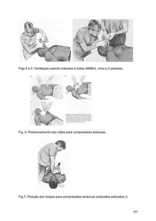 189
Figs.4 e 5. Ventilação usando máscara e bolsa (AMBU). Uma e 2 pessoas.
Fig. 6. Posicionamento das mãos para compressões torácicas.
Fig.7. Posição dos braços para compressões torácicas (cotovelos esticados !).
 