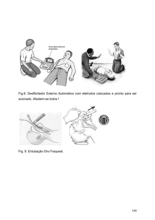 190
Fig.8. Desfibrilador Externo Automático com eletrodos colocados e pronto para ser
acionado. Afastem-se todos !
Fig. 9. Entubação Oro-Traqueal.
 