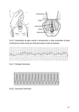 191
Fig.10. Visualização da glote usando o laringoscópio e visão aumentada da glote
mostrando as cordas vocais por onde deve passar o tubo oro-traqueal.
Fig.11. Fibrilação Ventricular.
Fig.12. Taquicardia Ventricular.
 