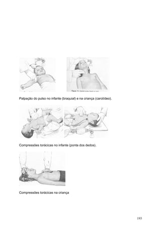 193
Palpação do pulso no infante (braquial) e na criança (carotídeo).
Compressões torácicas no infante (ponta dos dedos).
Compressões torácicas na criança
 