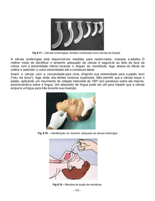 Fig 8.17 – Cânulas orofaríngeas, também conhecidas como cânulas de Guedel.

A cânula orofaríngea está disponível em medidas para recém-natos, crianças e adultos. O
melhor modo de identificar o tamanho adequado da cânula é segurá-Ia ao lado da face da
vítima, com a extremidade inferior tocando o ângulo da mandíbula, logo abaixo do lóbulo da
orelha e estender a outra extremidade até a comissura labial.
Inserir a cânula com a concavidade para cima, dirigindo sua extremidade para o palato duro
("céu da boca"), logo atrás dos dentes incisivos superiores. Não permitir que a cânula toque o
palato, aplicando um movimento de rotação helicoidal de 180º (em parafuso) sobre ela mesma,
posicionando-a sobre a língua. Um abaixador de língua pode ser útil para impedir que a cânula
empurre a língua para trás durante sua inserção.




                   Fig 8.18 – Identificação do tamanho adequado da cânula orofaríngea




                                Fig 8.19 – Manobra de tração de mandíbula.

                                                 - 101 -
 