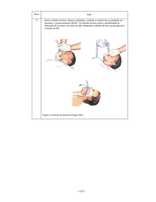 Passo                                                  Ação

 4        Insira o abridor de boca, forneça ventilação e continue a monitorizar as condições do
          paciente e o posicionamento da ML. Um abridor de boca reduz a possibilidade de
          obstrução da via aérea e de lesão do tubo. Mantenha o abridor de boca em posição até a
          remoção da ML.




        Figura 8. Inserção da máscara laríngea (ML).




                                             - 113 -
 