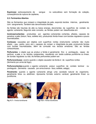 Equimose: extravasamento de          sangue           no subcutâneo sem formação de coleção,
conseqüência da ruptura de capilares.

2.2. Ferimentos Abertos

São os ferimentos que rompem a integridade da pele, expondo tecidos internos, geralmente
com sangramento. Também são denominados feridas.
As feridas são traumas de alta ou baixa energia, decorrentes da superfície de contato do
agente vulnerante. Segundo este conceito, as feridas podem ser classificadas em:

Incisivas/cortantes: produzidas por agentes vulnerantes cortantes, afiados, capazes de
penetrar a pele (bisturi, faca, estilete etc), produzindo ferida linear com bordas regulares e pouco
traumatizadas.
Contusas: causadas por objetos com superfície romba (instrumento cortante não muito
afiado - pau, pedra, soco etc.), capazes de romper a integridade da pele, produzindo feridas
com bordas traumatizadas, além de contusão nos tecidos arredores. São as feridas
cortocontusas.
Perfurantes: o objeto que as produz a ferida é geralmente fino e pontiagudo, capaz de
perfurar a pele e os tecidos subjacentes, resultando em lesão cutânea puntiforme ou linear,
de bordas regulares ou não. As feridas perfurantes podem ser:
Perfurocontusas: ocorre quando o objeto causador da ferida é de superfície romba
(ferimento por arma de fogo);

Perfurocortantes:quando o agente vulnerante possui superfície de contato laminar                 ou
pontiagudo (ferimento causado por arma branca - faca, estilete, adaga).
Penetrante: quando o agente vulnerante atinge uma cavidade natural do organismo,
geralmente tórax ou abdômen. Apresenta formato externo variável, geralmente linear ou
puntiforme.




Fig 11.7 – Ferida transfixante       Fig 11.8 – Ferida transfixante




                                                - 133 -
 