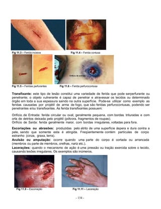 Fig 11.3 – Ferida incisiva                Fig 11.4 – Ferida contusa




Fig 11.5 – Feridas perfurantes   Fig 11.6 – Ferida perfurocontusa

Transfixante: este tipo de lesão constitui uma variedade de ferida que pode serperfurante ou
penetrante; o objeto vulnerante é capaz de penetrar e atravessar os tecidos ou determinado
órgão em toda a sua espessura saindo na outra superfície. Pode-se utilizar como exemplo as
feridas causadas por projétil de arma de fogo, que são feridas perfurocontusas, podendo ser
penetrantes e/ou transfixantes. As ferida transfixantes possuem:

Orifício de Entrada: ferida circular ou oval, geralmente pequena, com bordas trituradas e com
orla de detritos deixada pelo projétil (pólvora, fragmentos de roupas).
Orifício de Saída: ferida geralmente maior, com bordas irregulares, voltadas para fora.
Escoriações ou abrasões: produzidas pelo atrito de uma superfície áspera e dura contra a
pele, sendo que somente esta é atingida. Freqüentemente contém partículas de corpo
estranho (cinza, graxa, terra).
Avulsão ou amputação: ocorre quando uma parte do corpo é cortada ou arrancada
(membros ou parte de membros, orelhas, nariz etc.).
Lacerações: quando o mecanismo de ação é uma pressão ou tração exercida sobre o tecido,
causando lesões irregulares. Os exemplos são inúmeros.




    Fig 11.9 – Escoriação                  Fig 11.11 – Laceração


                                              - 134 -
 