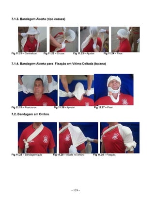 7.1.3. Bandagem Aberta (tipo cazuza)




Fig 11.21 – Centralizar.    Fig 11.22 – Cruzar.       Fig 11.23 – Ajustar.        Fig 11.24 – Fixar.



7.1.4. Bandagem Aberta para Fixação em Vítima Deitada (baiana)




Fig 11.25 – Posicionar.              Fig 11.26 – Ajustar.                Fig 11.27 – Fixar.

7.2. Bandagem em Ombro




Fig 11.28 – Bandagem guia           Fig 11.29 – Ajuste no ombro         Fig 11.30 – Fixação.




                                                     - 139 -
 