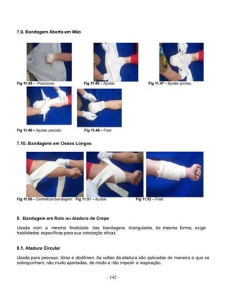7.9. Bandagem Aberta em Mão




Fig 11.45 – Posicionar.                 Fig 11.46 – Ajustar.           Fig 11.47 – Ajustar pontas.




Fig 11.48 – Ajustar pressão.            Fig 11.49 – Fixar.


7.10. Bandagens em Ossos Longos




Fig 11.50 – Centralizar bandagem. Fig 11.51 – Ajustar.          Fig 11.52 – Fixar.




8. Bandagem em Rolo ou Atadura de Crepe

Usada com a mesma finalidade das bandagens triangulares, da mesma forma, exige
habilidades específicas para sua colocação eficaz.


8.1. Atadura Circular

Usada para pescoço, tórax e abdômen. As voltas da atadura são aplicadas de maneira a que se
sobreponham, não muito apertadas, de modo a não impedir a respiração.


                                                      - 142 -
 