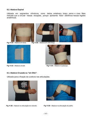 8.2. Atadura Espiral

Utilizada em segmentos cilíndricos, como dedos, antebraço, braço, perna e coxa. Mais
indicada que a circular nessas situações, porque apresenta maior aderência nessas regiões
anatômicas.




Fig 11.55 – Atadura em tórax.         Fig 11.56 – Atadura em ante braço.




Fig 11.53 – Atadura circular.                              Fig 11.54 – Atadura no pescoço.



8.3. Atadura Cruzada ou "em Oito":

Utilizada para a fixação de curativos nas articulações.




Fig 11.58 – Atadura na articulação do cotovelo.        Fig 11.59 – Atadura na articulação do joelho.




                                                      - 143 -
 