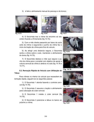 3) é feito o alinhamento manual do pescoço e do tronco;




 Fig. 14.75                          Fig. 14.76              Fig. 14.77

         4) O Socorrista traz a vítima de encontro ao seu
       ombro fixando–a firmemente (fig 14.74);

           5) Com a mão direita passando por baixo da outra
       axila da vítima e segurando o punho da vítima faz o
       inicio da tração da vítima para fora do veiculo;

          6) Ao atingir uma distancia segura, o Socorrista
                                                                   Fig. 14.78
       senta a vítima sobre o solo, mantendo o alinhamento
       do dorso (fig 14.75);

          7) O Socorrista desloca a mão que segura o pu-
       nho da vítima para o occipital com objetivo de apoiar a
       coluna cervical da vítima e deitá-lo no solo (fig 14.76 e
       14.77).
                                                                   Fig. 14.79
     9.2. Remoção Rápida de Veículo com Utilização de
Tábua

     Para vítimas no interior do veículo que necessitem de
remoção rápida, seguem-se os seguintes passos:

           1) O Socorrista 1 aborda fazendo o controle cervi-
       cal (fig 14.78);
                                                                   Fig. 14.80
          2) O Socorrista 2 assume a tração e alinhamento
       para colocação do colar cervical;

          3) O Socorrista 1 instala o colar cervical (fig
       14.79);

          4) O Socorrista 3 posiciona a tábua no banco ao
       próximo a vítima;                                           Fig. 14.81




                                          180
 