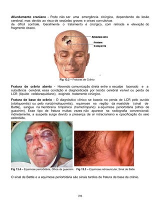 Afundamento craniano - Pode não ser uma emergência cirúrgica, dependendo da lesão
cerebral, mas devido ao risco de seqüelas graves e crises convulsivas
de difícil controle. Geralmente o tratamento é cirúrgico, com retirada e elevação do
fragmento ósseo.




                                        Fig 13.2 – Fraturas de Crânio

Fratura de crânio aberta - Havendo comunicação direta entre o escalpe lacerado e a
substância cerebral, essa condição é diagnosticada por tecido cerebral visível ou perda de
LCR (líquido cefaloraquidiano), exigindo tratamento cirúrgico.
Fratura de base de crânio - O diagnóstico clínico se baseia na perda de LCR pelo ouvido
(otoliquorréia) ou pelo nariz(rinoliquorréia), equimose na região da mastóide (sinal de
Battle), sangue na membrana timpânica (hemotímpano) e equimose periorbitária (olhos de
guaxinim). Esse tipo de fratura muitas vezes não aparece na radiografia convencional;
indiretamente, a suspeita surge devido a presença de ar intracraniano e opacificação do seio
esfenóide.




Fig 13.4 – Equimose periorbitária, Olhos de guaxinim   Fig 13.3 – Equimose retroauricular, Sinal de Batle


O sinal de Battle e a equimose periorbitária são sinais tardios de fratura de base de crânio.




                                                       198
 