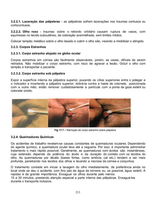 3.2.2.1. Laceração das pálpebras - as pálpebras sofrem lacerações nos traumas contusos ou
cortocontusos.

3.2.2.2. Olho roxo - traumas sobre o rebordo orbitário causam ruptura de vasos, com
equimoses no tecido subcutâneo, de coloração avermelhada, sem limites nítidos.
Colocar tampão metálico sobre o olho lesado e cobrir o olho são, visando a imobilizar o atingido.
3.2.3. Corpos Estranhos

3.2.3.1. Corpo estranho alojado no globo ocular

Corpos estranhos em córnea são facilmente observáveis, porém, as vezes, difíceis de serem
retirados. Não mobilizar o corpo estranho, com risco de agravar a lesão. Ocluir o olho com
tampão e transportar o paciente.

3.2.3.2. Corpo estranho sob pálpebra

Expor a superfície interna da pálpebra superior, puxando os cílios superiores entre o polegar e
o indicador e invertendo a pálpebra superior; dobrá-la contra a haste de cotonete, posicionada
com a outra mão; então remover cuidadosamente a partícula com a ponta de gaze estéril ou
cotonete úmido.




                               Fig 17.7 – Remoção de corpo estranho sobre pálpebra

3.2.4. Queimaduras Químicas

Os acidentes de trabalho revelam-se causas constantes de queimaduras oculares. Dependendo
do agente químico, a queimadura ocular leva até a cegueira. Por isso, é importante administrar
tratamento o mais rápido possível. Geralmente, as queimaduras com ácidos são instantâneas,
cuja extensão depende da potência do ácido e da duração do contato com os tecidos do
olho. As queimaduras por álcalis (bases fortes, como amônia, cal etc.) tendem a ser mais
profunda, penetrando nos tecidos dos olhos e levando a necrose da córnea e conjuntiva.
O tratamento consiste em iniciar a lavagem do olho imediatamente, de preferência ainda no
local onde se deu o acidente, com fino jato de água da torneira ou, se possível, água estéril. A
rapidez é de grande importância. Enxaguar os olhos durante pelo menos
15 a 30 minutos, prestando atenção especial a parte interna das pálpebras. Enxaguá-los
durante o transporte inclusive.


                                                213
 