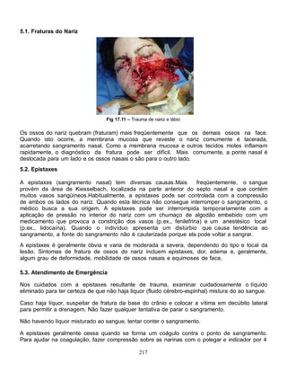 5.1. Fraturas do Nariz




                                 Fig 17.11 – Trauma de nariz e lábio

Os ossos do nariz quebram (fraturam) mais freqüentemente que os demais ossos na face.
Quando isto ocorre, a membrana mucosa que reveste o nariz comumente é lacerada,
acarretando sangramento nasal. Como a membrana mucosa e outros tecidos moles inflamam
rapidamente, o diagnóstico da fratura pode ser difícil. Mais comumente, a ponte nasal é
deslocada para um lado e os ossos nasais o são para o outro lado.
5.2. Epistaxes

A epistaxes (sangramento nasal) tem diversas causas.Mais         freqüentemente, o sangue
provém da área de Kiesselbach, localizada na parte anterior do septo nasal e que contém
muitos vasos sangüíneos.Habitualmente, a epistaxes pode ser controlada com a compressão
de ambos os lados do nariz. Quando esta técnica não consegue interromper o sangramento, o
médico busca a sua origem. A epistaxes pode ser interrompida temporariamente com a
aplicação de pressão no interior do nariz com um chumaço de algodão embebido com um
medicamento que provoca a constrição dos vasos (p.ex., fenilefrina) e um anestésico local
(p.ex., lidocaína). Quando o indivíduo apresenta um distúrbio que causa tendência ao
sangramento, a fonte do sangramento não é cauterizada porque ela pode voltar a sangrar.
A epistaxes é geralmente óbvia e varia de moderada a severa, dependendo do tipo e local da
lesão. Sintomas de fratura de ossos do nariz incluem epistaxes, dor, edema e, geralmente,
algum grau de deformidade, mobilidade de ossos nasais e equimoses de face.

5.3. Atendimento de Emergência

Nos cuidados com a epistaxes resultante de trauma, examinar cuidadosamente o líquido
eliminado para ter certeza de que não haja líquor (fluido cérebro-espinhal) mistura do ao sangue.

Caso haja líquor, suspeitar de fratura da base do crânio e colocar a vítima em decúbito lateral
para permitir a drenagem. Não fazer qualquer tentativa de parar o sangramento.

Não havendo líquor misturado ao sangue, tentar conter o sangramento.

A epistaxes geralmente cessa quando se forma um coágulo contra o ponto de sangramento.
Para ajudar na coagulação, fazer compressão sobre as narinas com o polegar e indicador por 4

                                                217
 