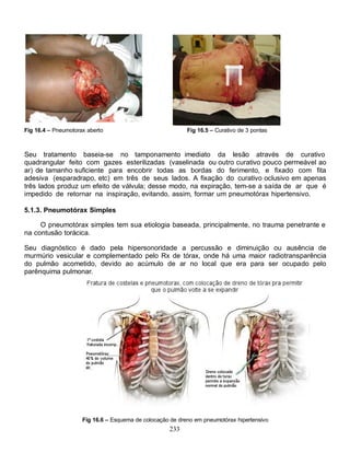 Fig 16.4 – Pneumotorax aberto                              Fig 16.5 – Curativo de 3 pontas



Seu tratamento baseia-se no tamponamento imediato da lesão através de curativo
quadrangular feito com gazes esterilizadas (vaselinada ou outro curativo pouco permeável ao
ar) de tamanho suficiente para encobrir todas as bordas do ferimento, e fixado com fita
adesiva (esparadrapo, etc) em três de seus lados. A fixação do curativo oclusivo em apenas
três lados produz um efeito de válvula; desse modo, na expiração, tem-se a saída de ar que é
impedido de retornar na inspiração, evitando, assim, formar um pneumotórax hipertensivo.

5.1.3. Pneumotórax Simples

     O pneumotórax simples tem sua etiologia baseada, principalmente, no trauma penetrante e
na contusão torácica.

Seu diagnóstico é dado pela hipersonoridade a percussão e diminuição ou ausência de
murmúrio vesicular e complementado pelo Rx de tórax, onde há uma maior radiotransparência
do pulmão acometido, devido ao acúmulo de ar no local que era para ser ocupado pelo
parênquima pulmonar.




                     Fig 16.6 – Esquema de colocação de dreno em pneumotórax hipertensivo
                                                    233
 