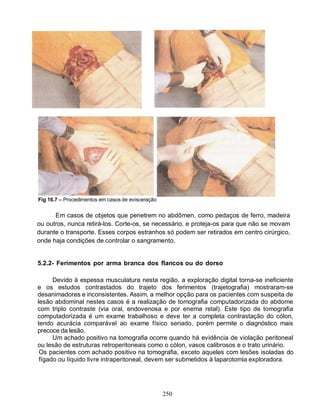 Fig 16.7 – Procedimentos em casos de evisceração


      Em casos de objetos que penetrem no abdômen, como pedaços de ferro, madeira
ou outros, nunca retirá-los. Corte-os, se necessário, e proteja-os para que não se movam
durante o transporte. Esses corpos estranhos só podem ser retirados em centro cirúrgico,
onde haja condições de controlar o sangramento.


5.2.2- Ferimentos por arma branca dos flancos ou do dorso

      Devido à espessa musculatura nesta região, a exploração digital torna-se ineficiente
e os estudos contrastados do trajeto dos ferimentos (trajetografia) mostraram-se
desanimadores e inconsistentes. Assim, a melhor opção para os pacientes com suspeita de
lesão abdominal nestes casos é a realização de tomografia computadorizada do abdome
com triplo contraste (via oral, endovenosa e por enema retal). Este tipo de tomografia
computadorizada é um exame trabalhoso e deve ter a completa contrastação do cólon,
tendo acurácia comparável ao exame físico seriado, porém permite o diagnóstico mais
precoce da lesão.
      Um achado positivo na tomografia ocorre quando há evidência de violação peritoneal
ou lesão de estruturas retroperitoneais como o cólon, vasos calibrosos e o trato urinário.
 Os pacientes com achado positivo na tomografia, exceto aqueles com lesões isoladas do
 fígado ou líquido livre intraperitoneal, devem ser submetidos à laparotomia exploradora.




                                                   250
 
