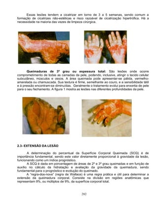 Essas lesões tendem a cicatrizar em torno de 3 a 5 semanas, sendo comum a
formação de cicatrizes não-estéticas e risco razoável de cicatrização hipertrófica. Há a
necessidade na maioria das vezes de limpeza cirúrgica.




       Queimaduras de 3º grau ou espessura total: São lesões onde ocorre
comprometimento de todas as camadas da pele, podendo, inclusive, atingir o tecido celular
subcutâneo, músculos e ossos. A área queimada pode apresentar-se pálida, vermelho-
amarelada ou chamuscada. Sua textura é firme, semelhante ao couro, e a sensibilidade tátil
e à pressão encontram-se diminuídas. Geralmente o tratamento evolui para enxertia de pele
para o seu fechamento. A figura 1 mostra as lesões nas diferentes profundidades da pele.




2.3- EXTENSÃO DA LESÃO

       A determinação do percentual da Superfície Corporal Queimada (SCQ) é de
importância fundamental, sendo este valor diretamente proporcional à gravidade da lesão,
funcionando como um índice prognóstico.
       A SCQ é dada em porcentagem de áreas de 2º e 3º grau queimadas e em função de
auxílio no cálculo da hidratação e avaliação da gravidade da queimadura, sendo
fundamental para o prognóstico e evolução do queimado.
       A “regra-dos-nove” (regra de Wallace) é uma regra prática e útil para determinar a
extensão da queimadura corporal. Consiste na divisão em regiões anatômicas que
representam 9%, ou múltiplos de 9%, da superfície corporal total.



                                            282
 
