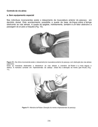 Controle da via aérea

a. Sem equipamento especial

Nos indivíduos inconscientes existe o relaxamento da musculatura anterior do pescoço, em
decúbito dorsal. Este acontecimento possibilita a queda da base da língua sobre a faringe
obstruindo as vias aéreas. A queda da epiglote, indiretamente, também é um fator obstrutivo a
passagem do ar para a traquéia (Fig. 10).




Figura 10 - Na vítima inconsciente existe o relaxamento da musculatura anterior do pescoço, com obstrução das vias aéreas
superiores.
Entre as manobras destinadas a desobstruir as vias aéreas a manobra de Ruben é a mais segura e
efetiva. A manobra consiste em: hiperextensão da cabeça (head tilt) e elevação do mento (jaw thrust) (Fig.
11).




                     Figura 11 - Manobra de Ruben. Elevação do mento e hiperextensão do pescoço.




                                                          336
 