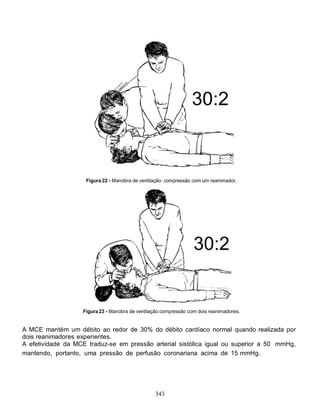 Figura 22 - Manobra de ventilação: compressão com um reanimador.




                   Figura 23 - Manobra de ventilação:compressão com dois reanimadores.


A MCE mantém um débito ao redor de 30% do débito cardíaco normal quando realizada por
dois reanimadores experientes.
A efetividade da MCE traduz-se em pressão arterial sistólica igual ou superior a 50 mmHg,
mantendo, portanto, uma pressão de perfusão coronariana acima de 15 mmHg.




                                                 343
 