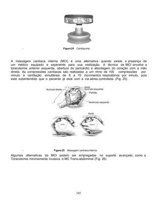 Figura 24    Cardiopump




A massagem cardíaca interna (MCI) é uma alternativa quando existe a presença de
um médico equipado e experiente para sua realização. A técnica da MCI envolve a
toracotomia anterior esquerda, abertura do pericárdio e abordagem do coração com a mão
direita. As compressões cardíacas são realizadas a um ritmo de 100 compressões por
minuto e ventilação simultânea de 8 a 10 movimentos respiratórios por minuto, pois
está subentendido que o paciente já está com a via aérea controlada. (Fig. 25)




                           Figura 25   Massagem cardíaca interna.

Algumas alternativas da MCI podem ser empregadas no suporte avançado, como a
Toracotomia minimamente invasiva e MC Trans-abdominal (Fig. 26)




                                              345
 